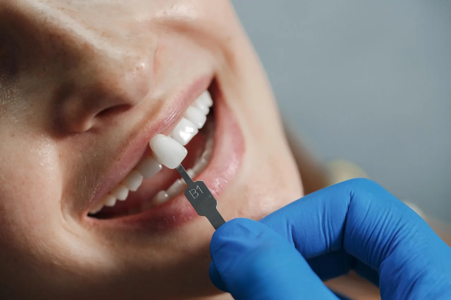 Implantes dentales